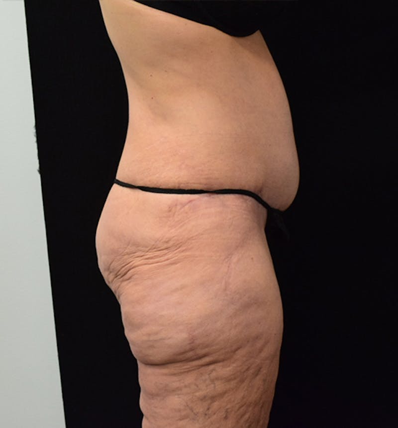 Lower Body Lift Before & After Gallery - Patient 102567206 - Image 8
