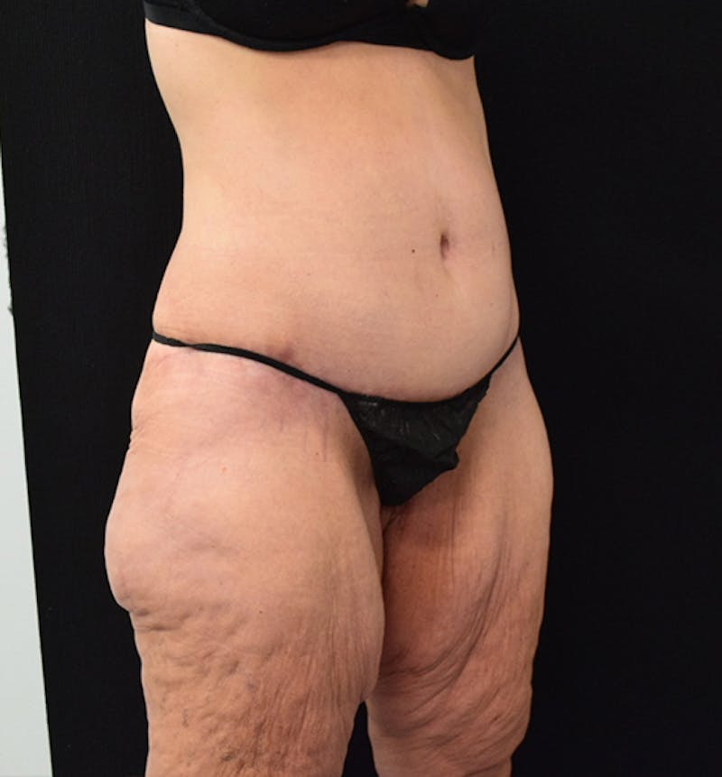 Lower Body Lift Gallery - Patient 102567206 - Image 10