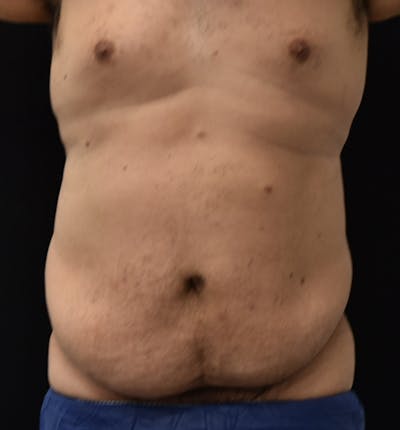 Lower Body Lift Before & After Gallery - Patient 148037533 - Image 1