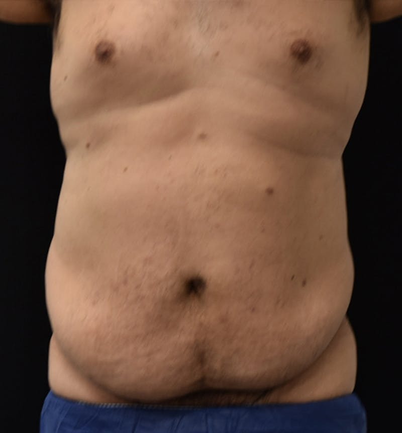 Male Lower Body Lift Before & After Gallery - Patient 148037533 - Image 1