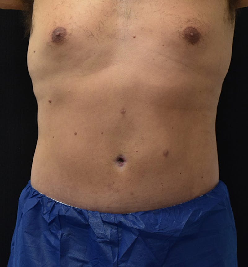 Male Lower Body Lift Before & After Gallery - Patient 148037533 - Image 2