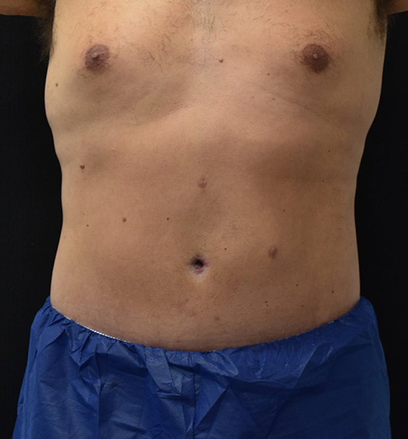 Lower Body Lift Before & After Gallery - Patient 102567226 - Image 2