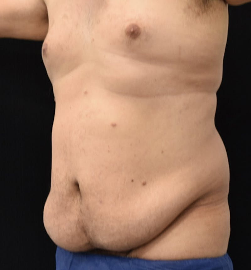 Male Lower Body Lift Before & After Gallery - Patient 148037533 - Image 3