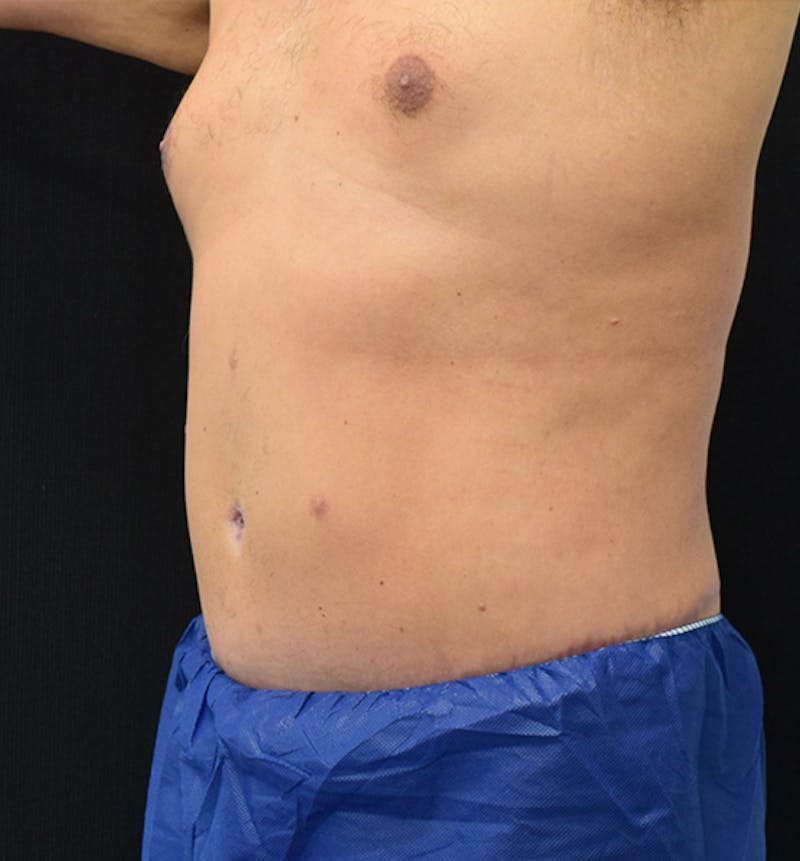 Male Lower Body Lift Before & After Gallery - Patient 148037533 - Image 4