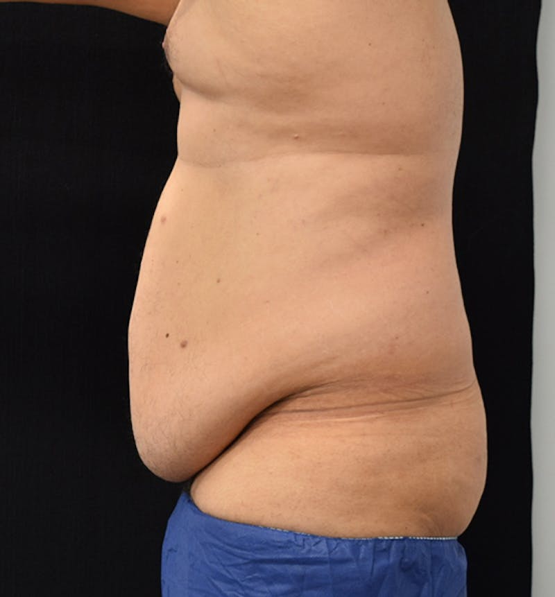 Male Lower Body Lift Before & After Gallery - Patient 148037533 - Image 5