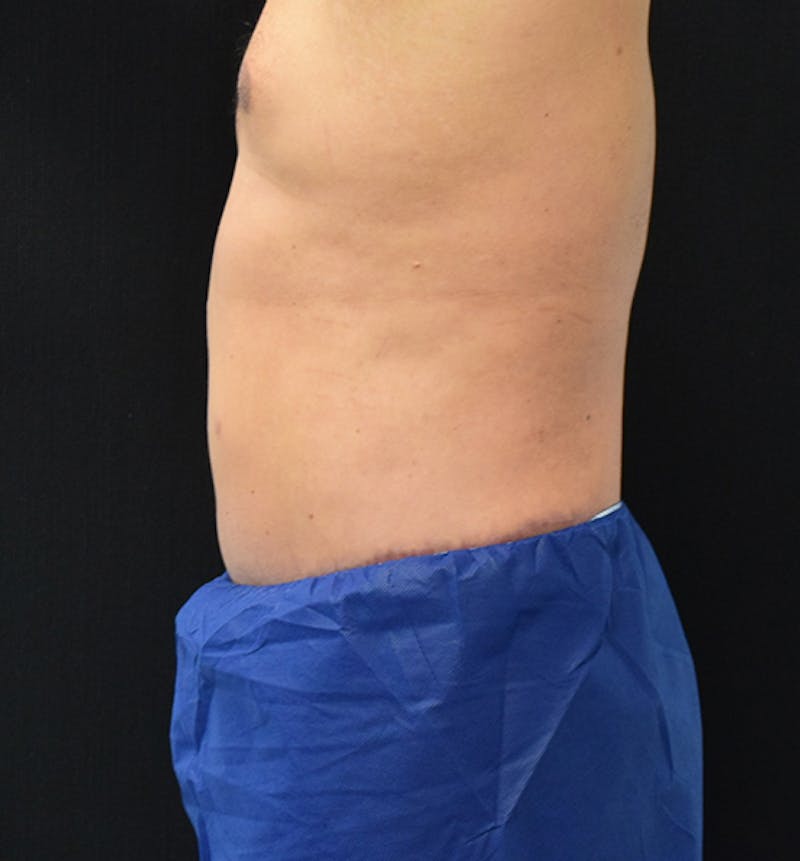 Male Lower Body Lift Before & After Gallery - Patient 148037533 - Image 6