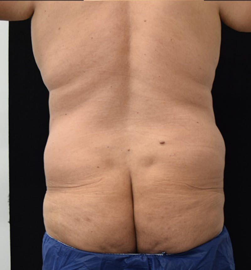 Male Lower Body Lift Before & After Gallery - Patient 148037533 - Image 7