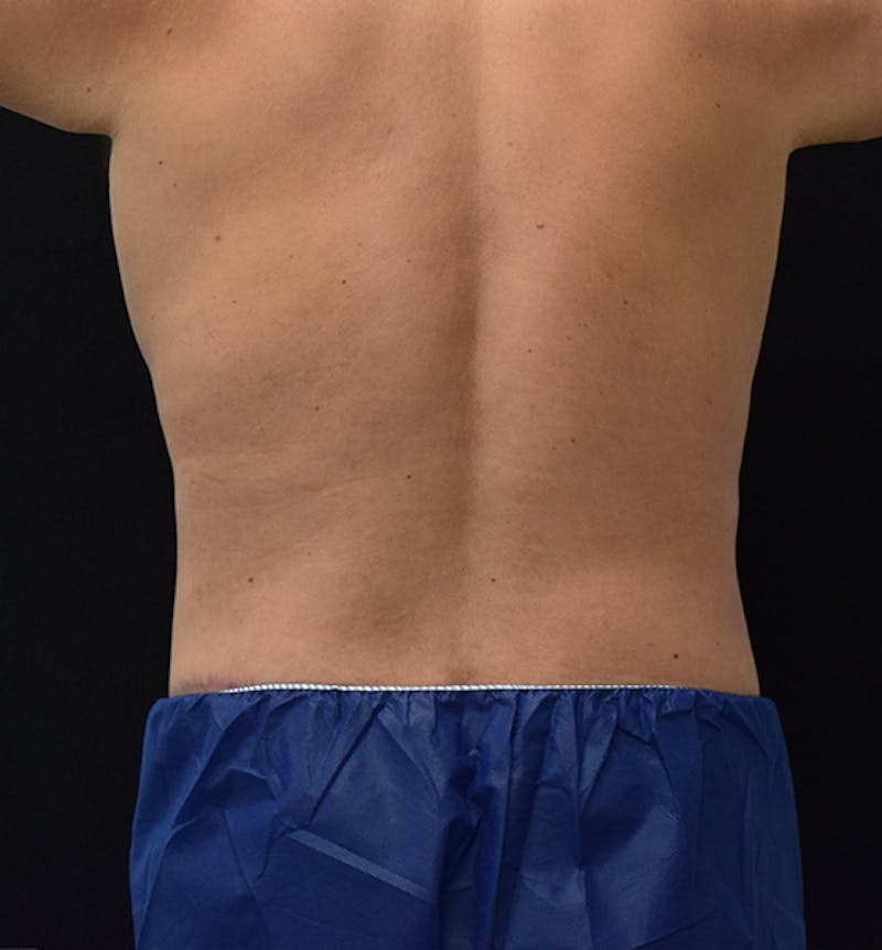 Male Lower Body Lift Before & After Gallery - Patient 148037533 - Image 8