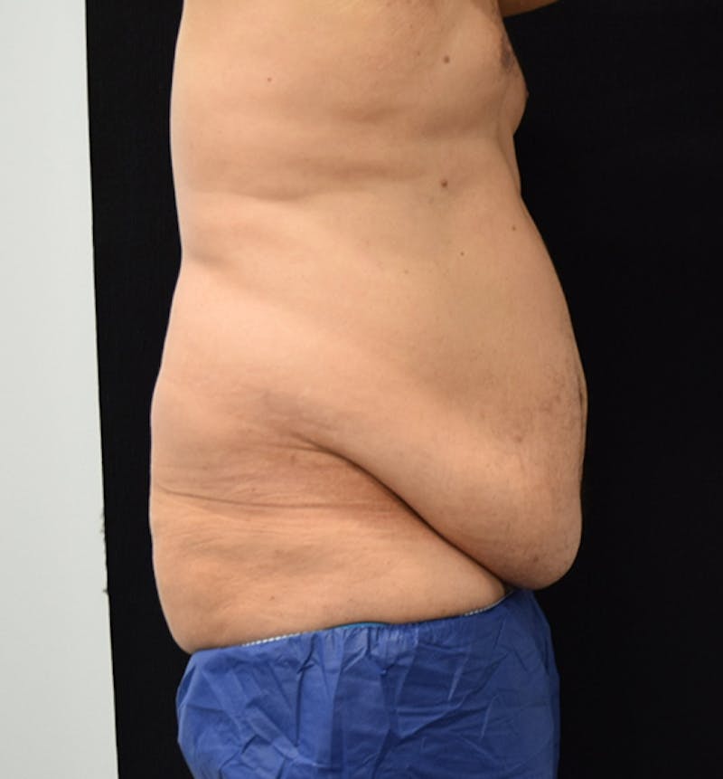 Male Lower Body Lift Before & After Gallery - Patient 148037533 - Image 9