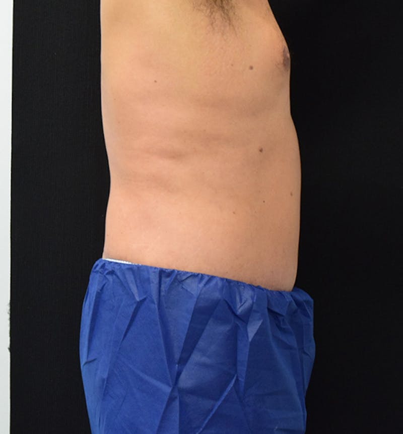 Male Lower Body Lift Before & After Gallery - Patient 148037533 - Image 10
