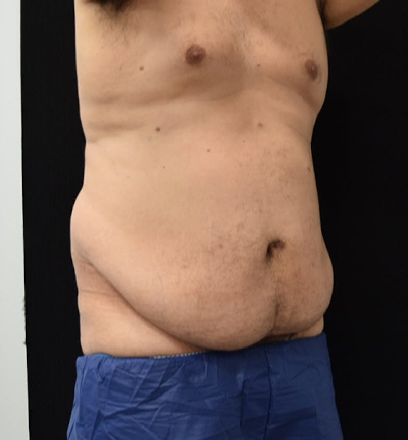 Male Lower Body Lift Before & After Gallery - Patient 148037533 - Image 11
