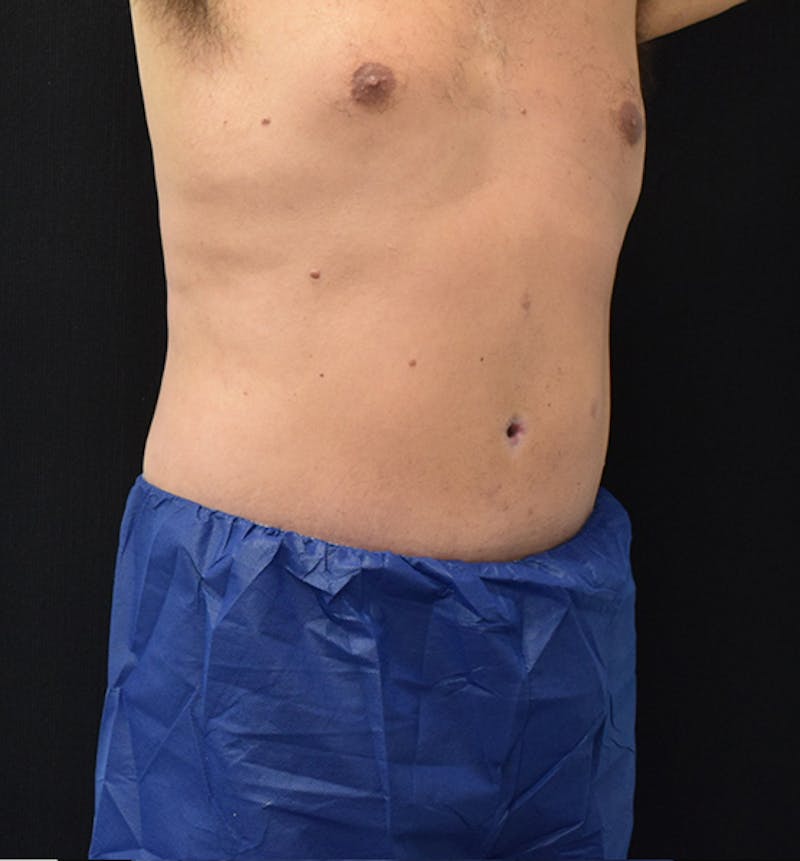 Lower Body Lift Before & After Gallery - Patient 148037533 - Image 12