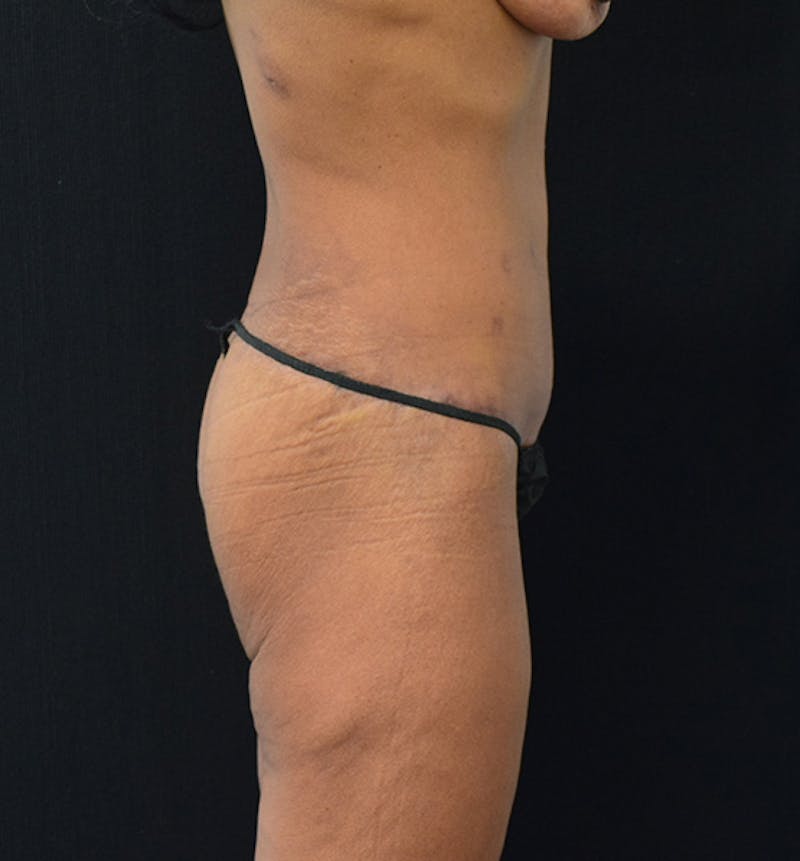 Lower Body Lift Before & After Gallery - Patient 102567374 - Image 12