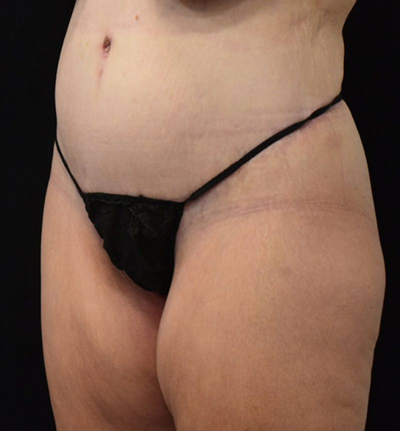 Lower Body Lift Before & After Gallery - Patient 102567386 - Image 4