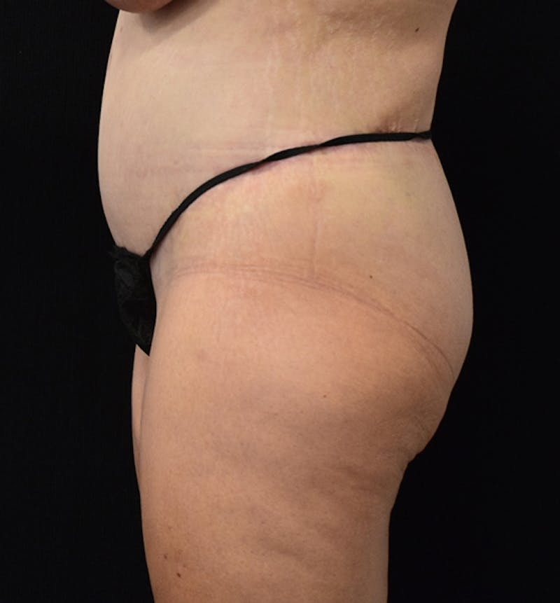 Lower Body Lift Before & After Gallery - Patient 102567386 - Image 6
