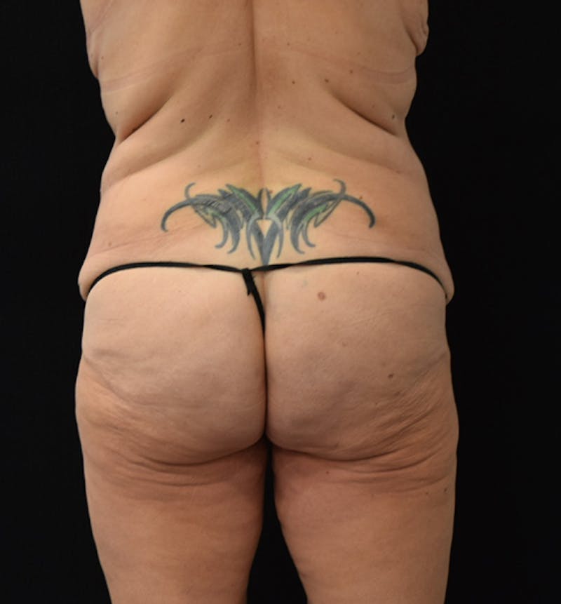 Lower Body Lift Gallery - Patient 102567386 - Image 7