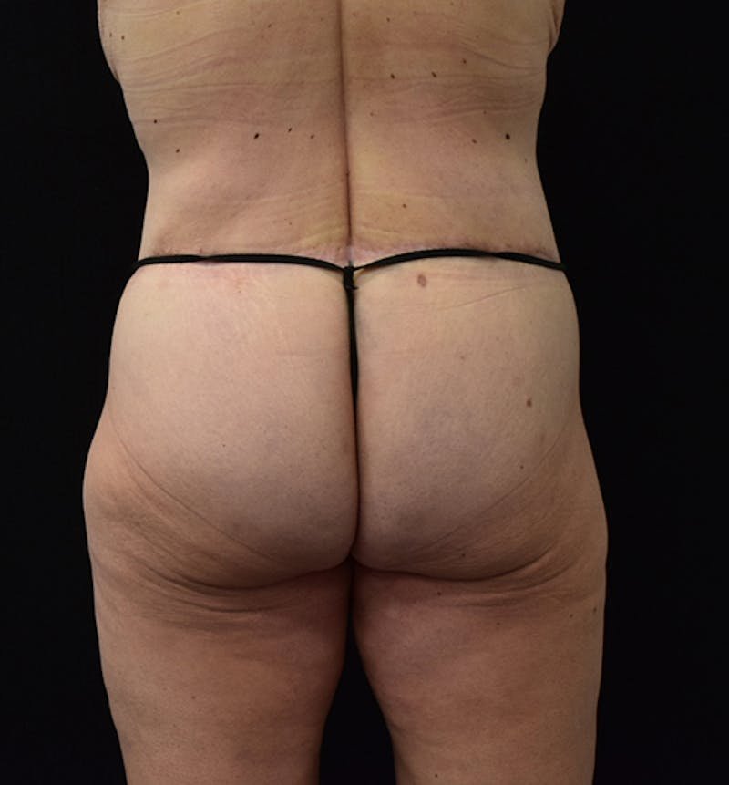 Lower Body Lift Before & After Gallery - Patient 102567386 - Image 8