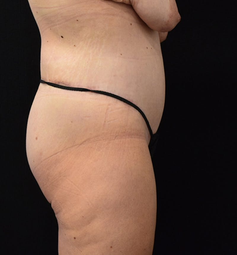 Lower Body Lift Before & After Gallery - Patient 102567386 - Image 10