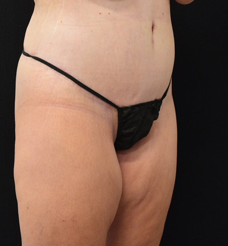 Lower Body Lift Before & After Gallery - Patient 102567386 - Image 12
