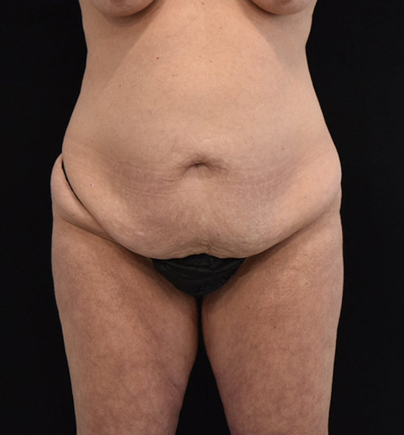 Lower Body Lift Before & After Gallery - Patient 102567418 - Image 1