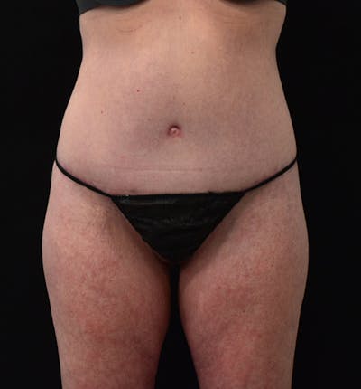 Lower Body Lift Before & After Gallery - Patient 102567418 - Image 2
