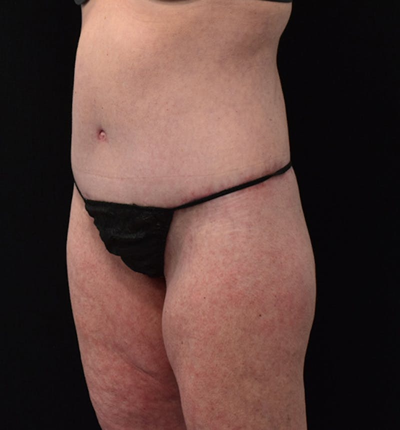 Lower Body Lift Before & After Gallery - Patient 102567418 - Image 4