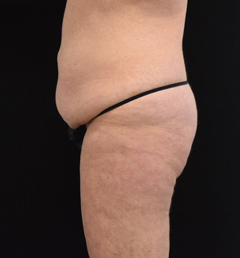 Lower Body Lift Before & After Gallery - Patient 102567418 - Image 5