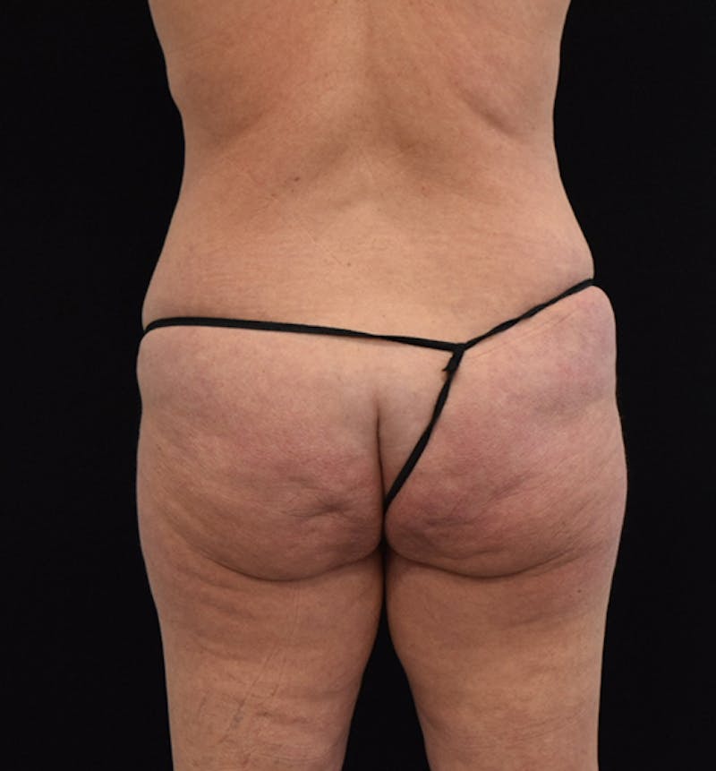 Lower Body Lift Gallery - Patient 102567418 - Image 7