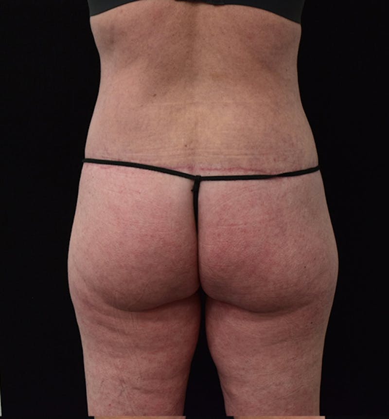 Lower Body Lift Gallery - Patient 102567418 - Image 8