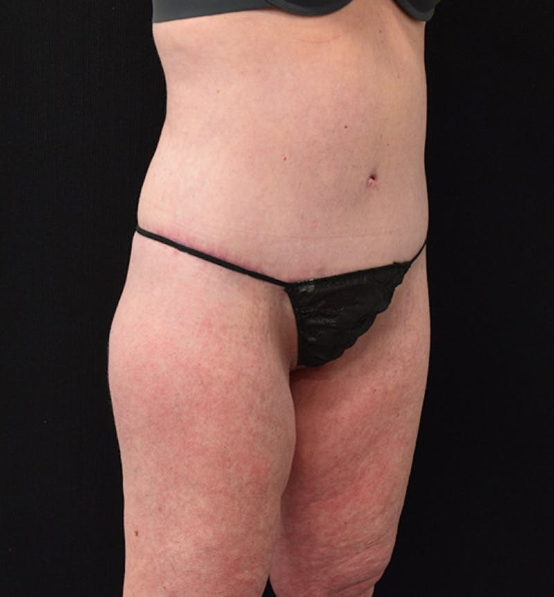 Lower Body Lift Before & After Gallery - Patient 102567418 - Image 10
