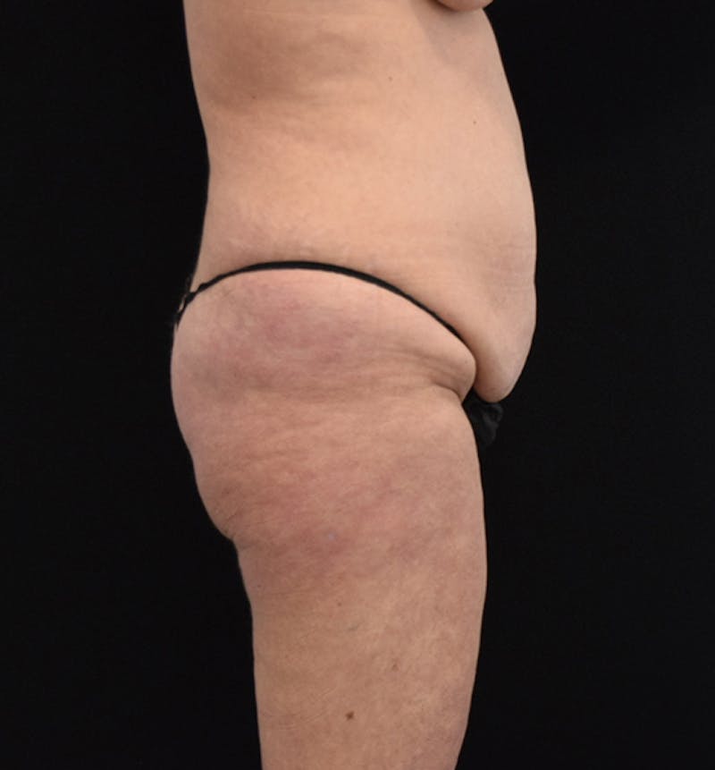 Lower Body Lift Before & After Gallery - Patient 102567418 - Image 11