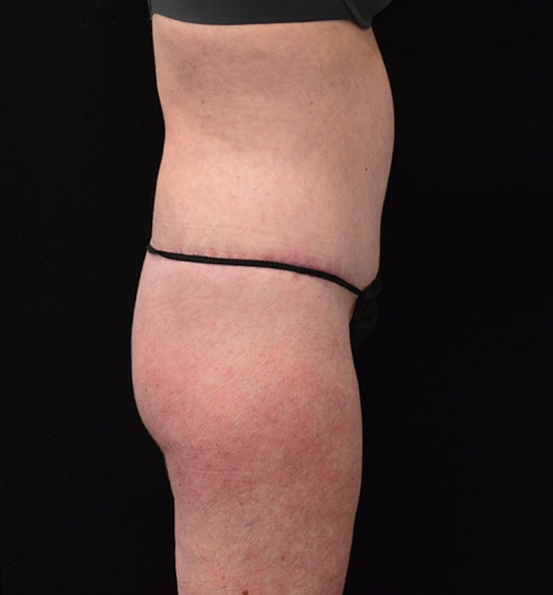 Lower Body Lift Before & After Gallery - Patient 102567418 - Image 12