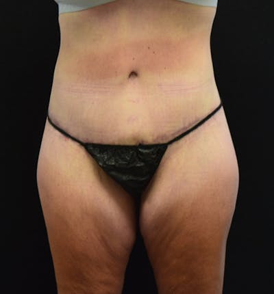 Lower Body Lift Before & After Gallery - Patient 102567423 - Image 2