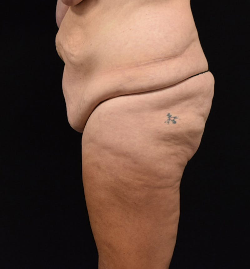 Lower Body Lift Before & After Gallery - Patient 102567423 - Image 3