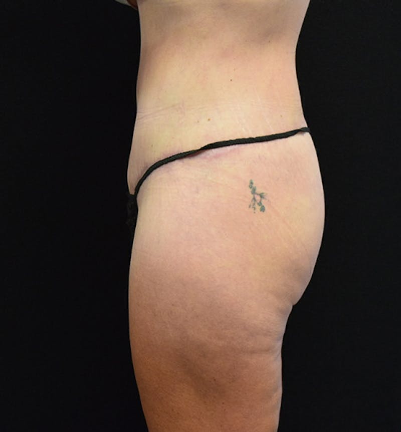 Lower Body Lift Before & After Gallery - Patient 102567423 - Image 4
