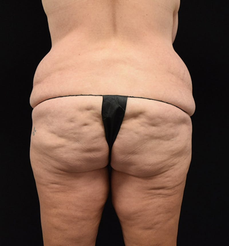 Lower Body Lift Before & After Gallery - Patient 102567423 - Image 5