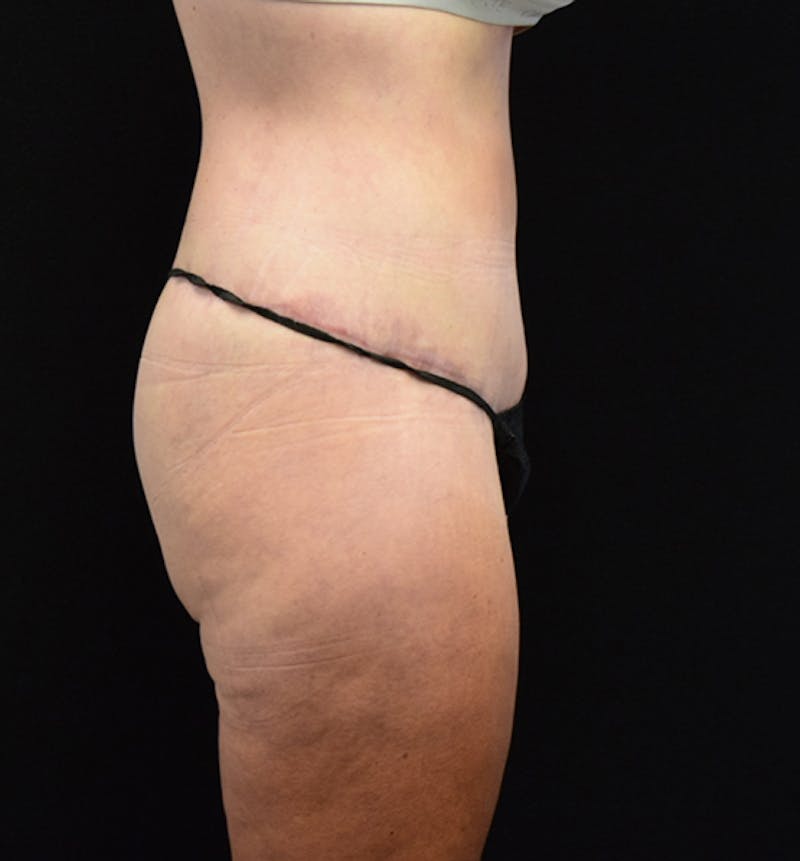 Lower Body Lift Before & After Gallery - Patient 102567423 - Image 8