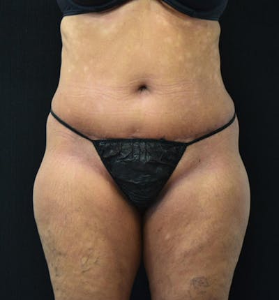 Lower Body Lift Before & After Gallery - Patient 102567461 - Image 2