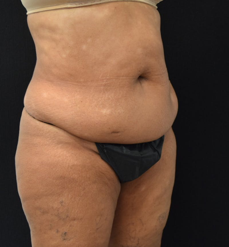 Lower Body Lift Before & After Gallery - Patient 102567461 - Image 3