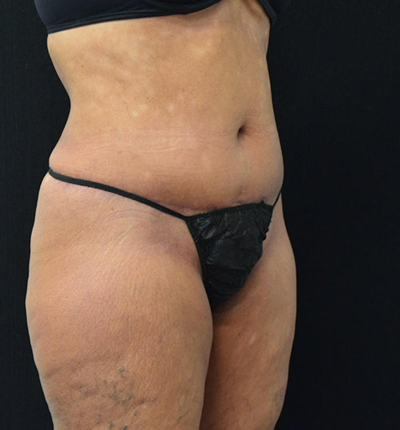 Lower Body Lift Before & After Gallery - Patient 102567461 - Image 4