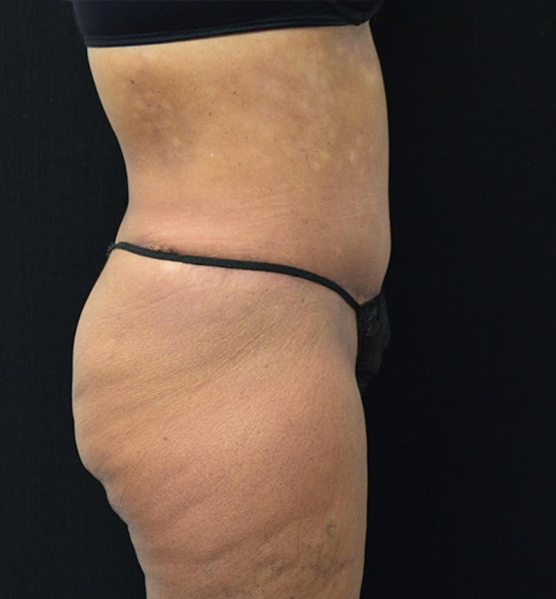 Lower Body Lift Before & After Gallery - Patient 102567461 - Image 6