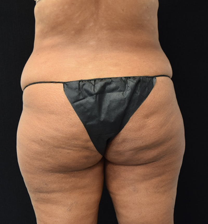 Lower Body Lift Before & After Gallery - Patient 102567461 - Image 7