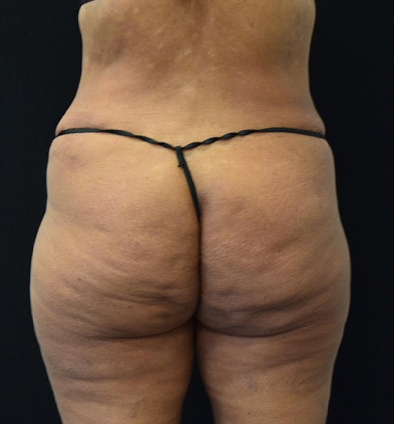 Lower Body Lift Gallery - Patient 102567461 - Image 8