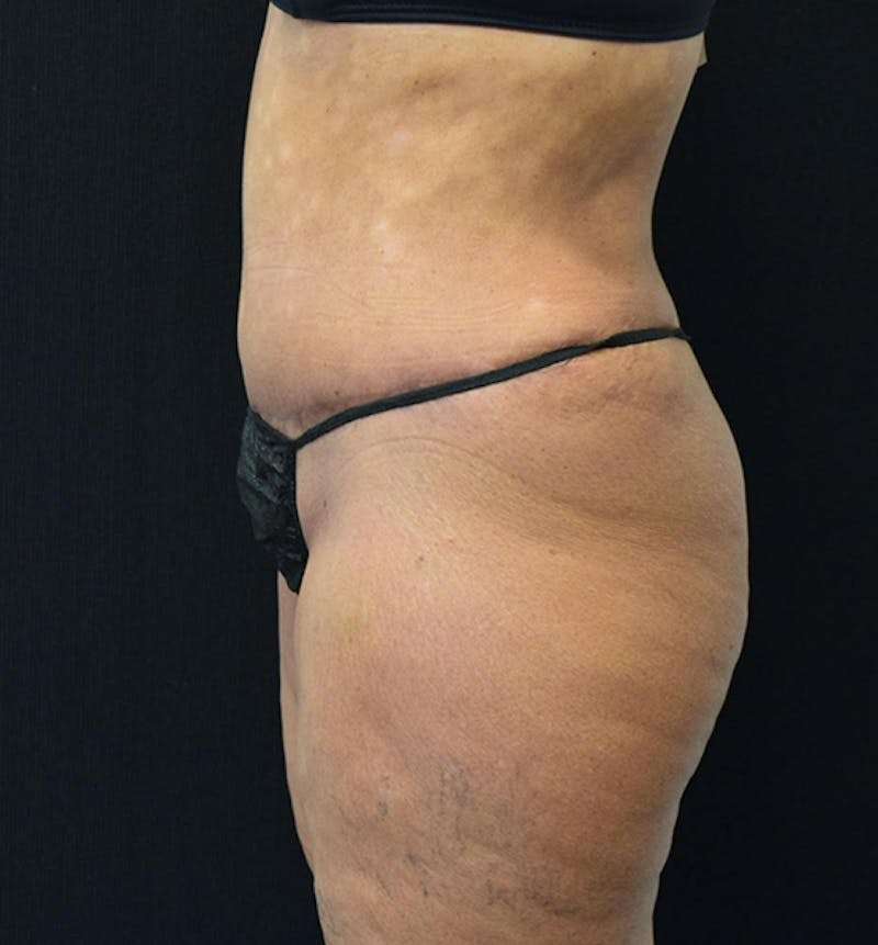 Lower Body Lift Before & After Gallery - Patient 102567461 - Image 10