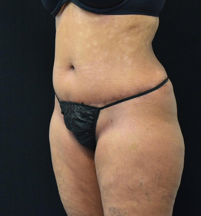 Lower Body Lift Before & After Gallery - Patient 102567461 - Image 12