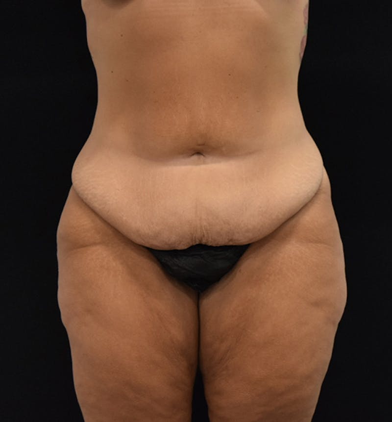 Lower Body Lift Before & After Gallery - Patient 102567713 - Image 1