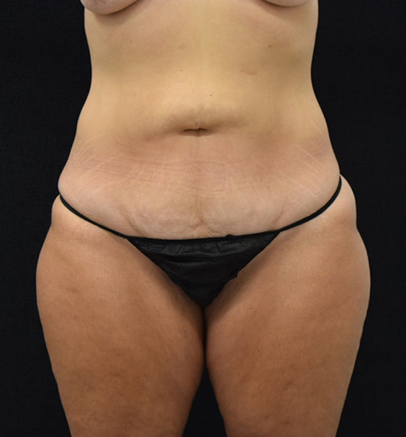 Lower Body Lift Before & After Gallery - Patient 102567772 - Image 1