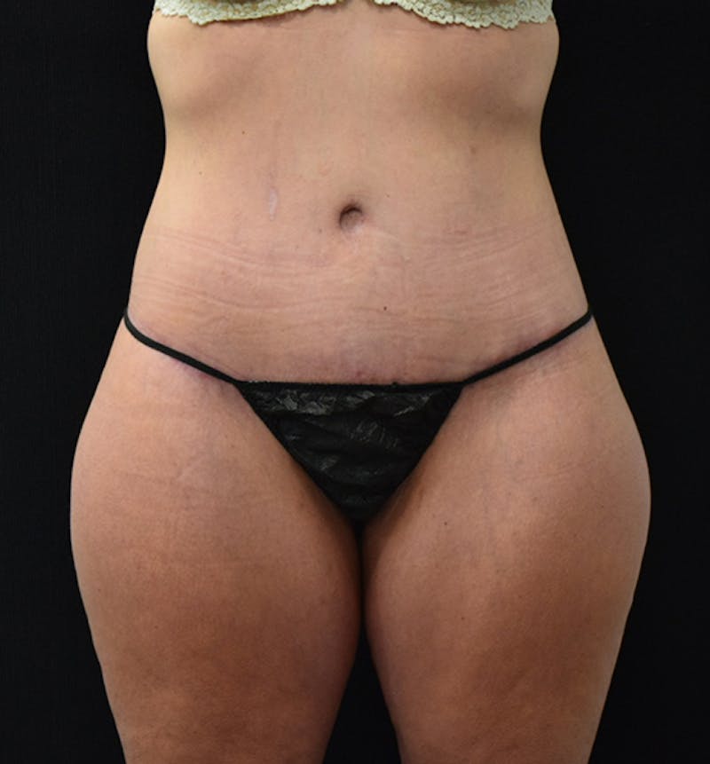 Lower Body Lift Before & After Gallery - Patient 102567772 - Image 2