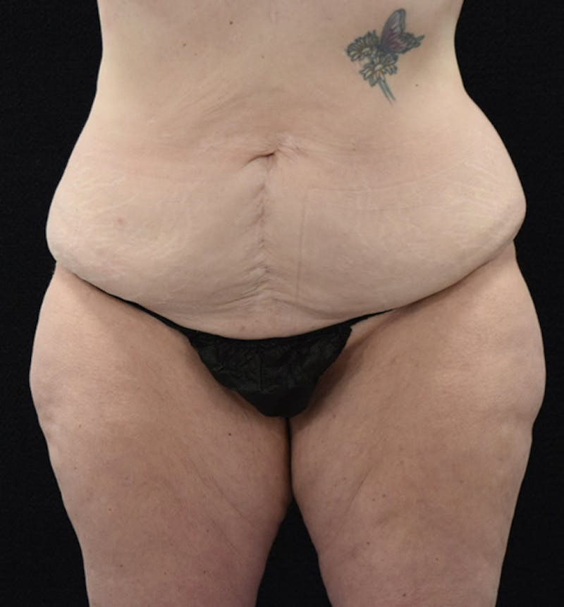 Lower Body Lift Before & After Gallery - Patient 102567856 - Image 1