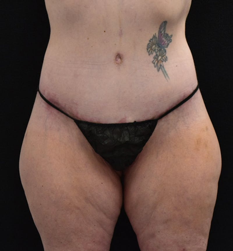Lower Body Lift Before & After Gallery - Patient 102567856 - Image 2